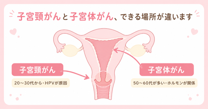 子宮頸がんと子宮体がん、できる場所の違い