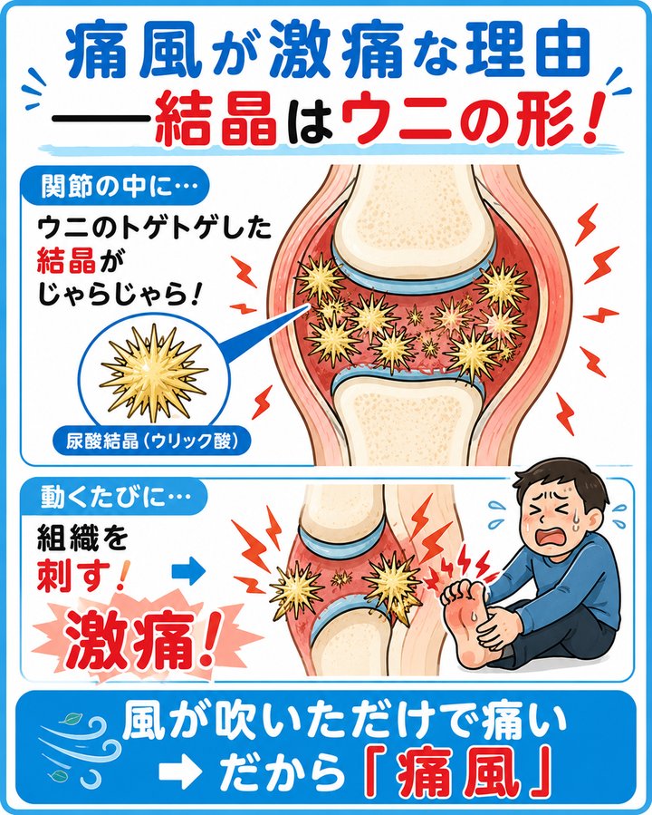 痛風が激痛な理由——結晶はウニの形！